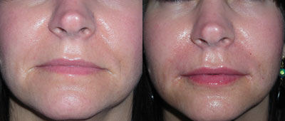 Juvederm to lips